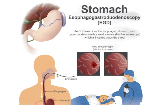 Esophagogastroduodenoscopy (EGD’S)