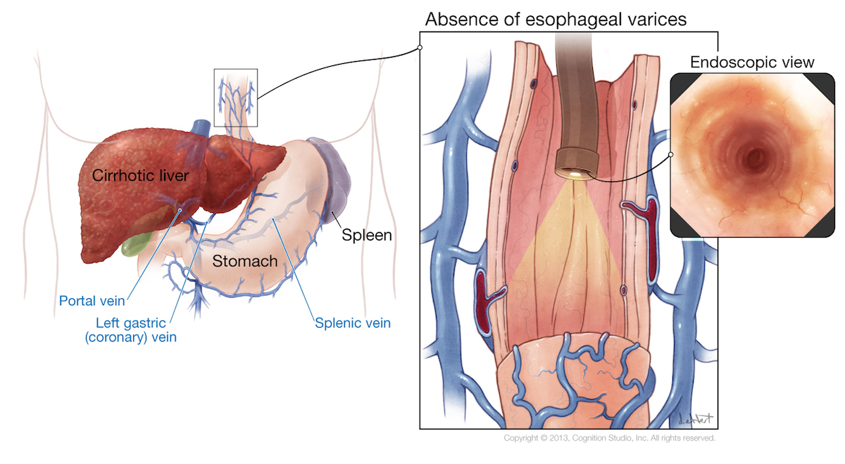 Endoscopic Variceal Banding