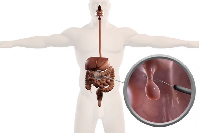 Endoscopic Mucosal Resection (EMR)