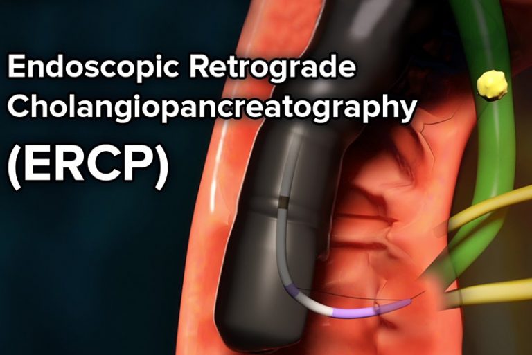 Endoscopic Retrograde Cholangiopancreatography (ERCP)