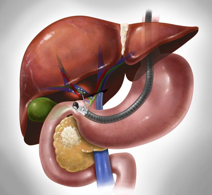 Endoscopic Ultrasound (EUS)