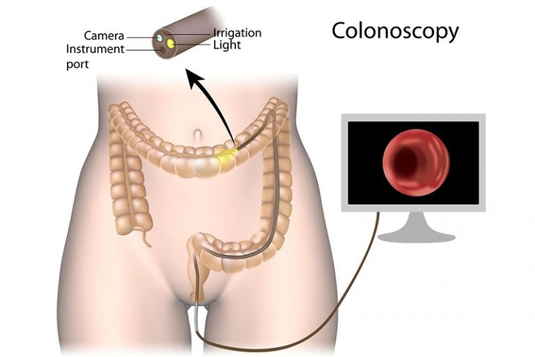 Colonoscopy