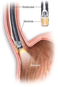 Halo Radio Frequency Ablation System